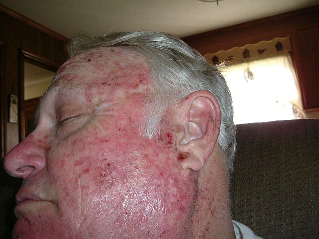 260712 001 Fluorouracil 002.jpg