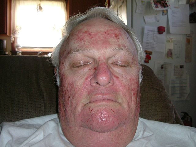 260712 001 Fluorouracil 001.jpg